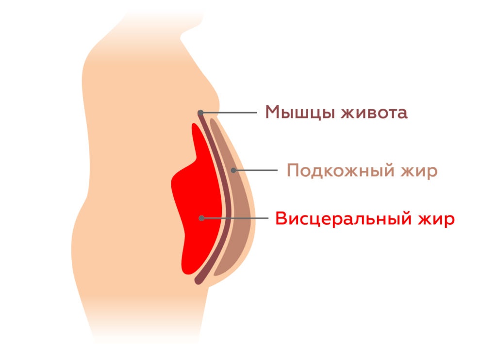 В норме на внутренний жир приходится не более 10% от общего количества жировой ткани, на подкожный — около 80%