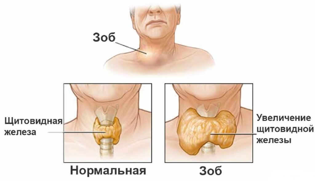 При длительном дефиците йода щитовидная железа увеличивается в размерах, что в результате приводит к появлению зоба