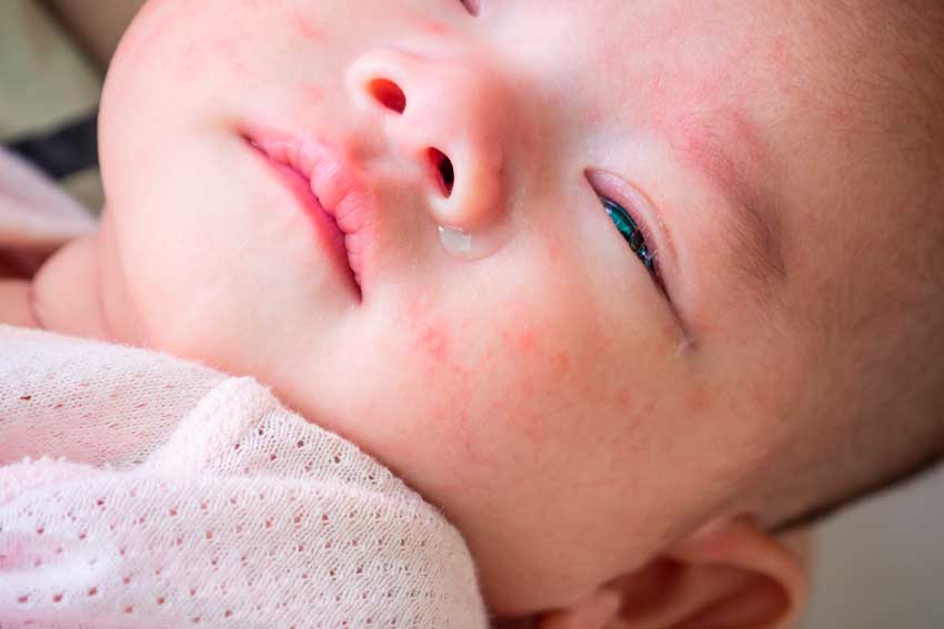 Как выглядит пищевая аллергия у малышей